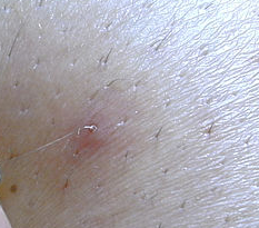 The tips you have to know about dealing with ingrown hair problem