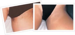 Review of waxing and shaving for bikini line hair removal