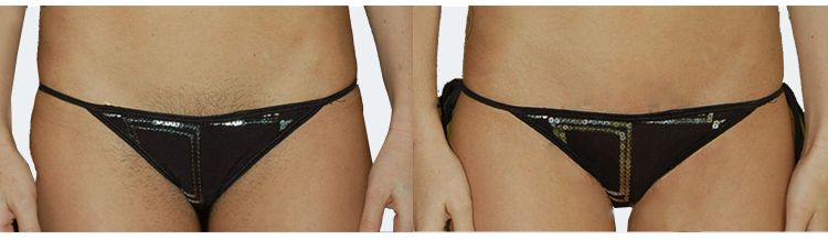 Study the possibilities of bikini hair removal