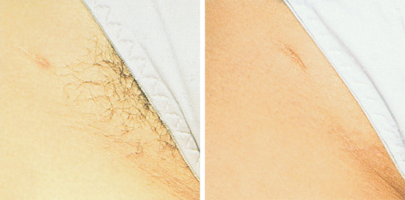 Comprehensive review of Hair Removal Products