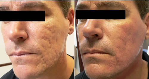 Non-Ablative Resurfacing in Skin Rejuvenation